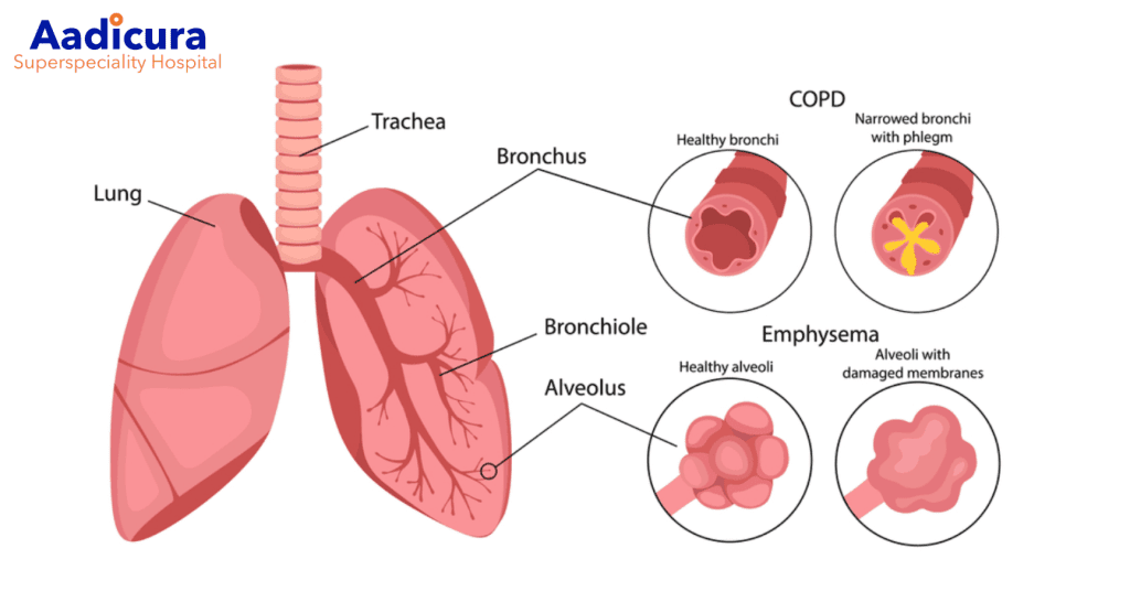 Understanding COPD: Symptoms ,Diagnosis & Management