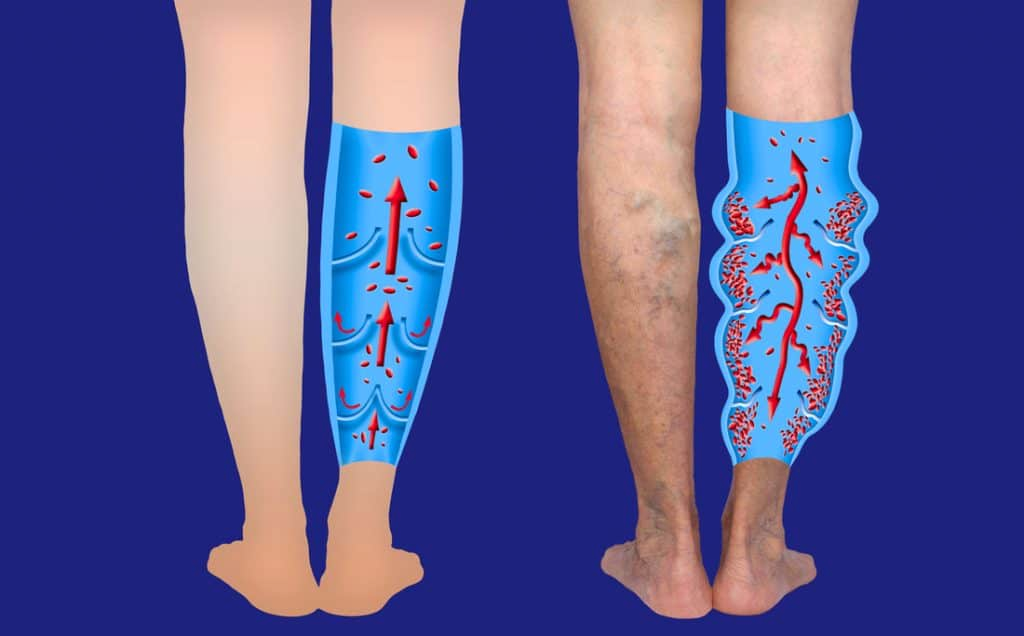 showing chronic venous insufficiency in the leg