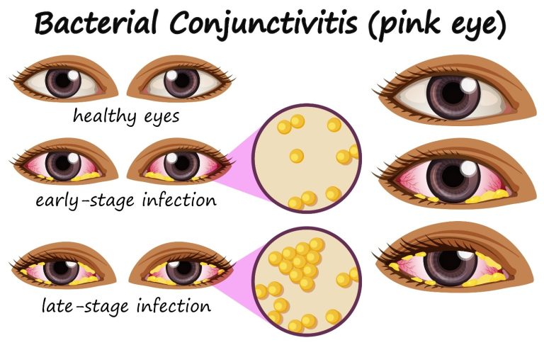 Pink Eye- Symptoms, Causes and Treatment