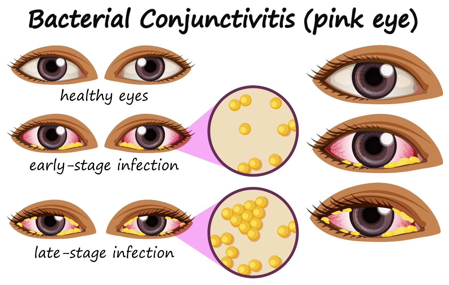 How Long Does Pink Eye Bacteria Stay On Surfaces