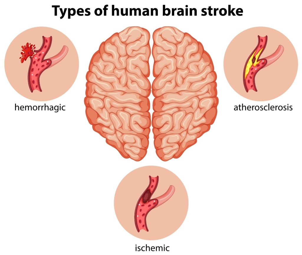 Brain and how different types of stroke occur